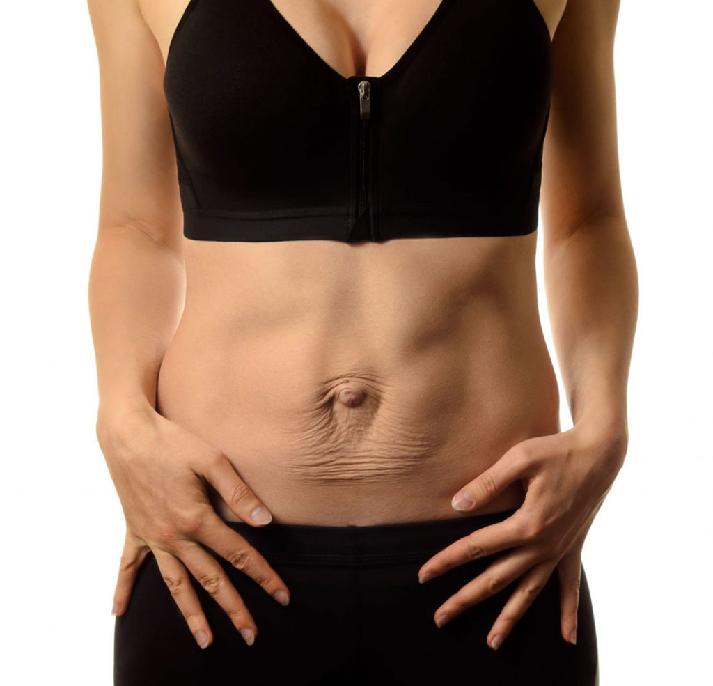 Diastasis Rectus Abdominus (DRA)