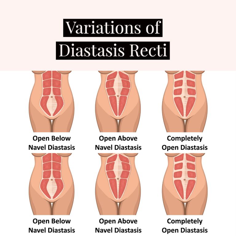 Body Connect Health & Wellness - Let's start by talking about one of the  most common and talked about postpartum issues: Diastasis recti. . Diastasis  Rectus Abdominis or Diastasis Recti (DRA) refers